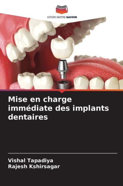 Mise en charge immï¿½diate des implants dentaires by Vishal Tapadiya