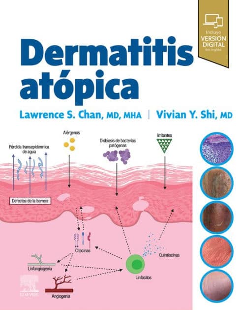 Dermatitis atópica by MHA Chan MD.