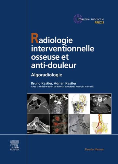 Radiologie Interventionnelle osseuse et anti-douleur: Algoradiologie by Bruno Kastler