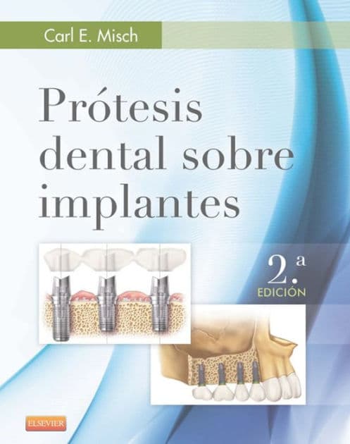 Prótesis dental sobre implantes by MDS Misch DDS