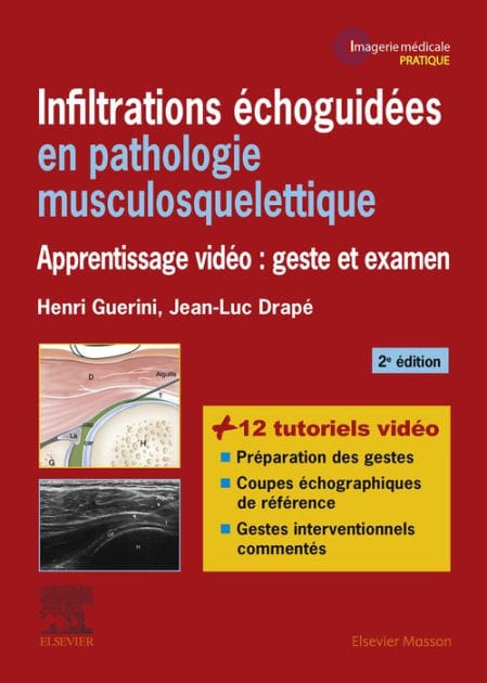 Infiltrations échoguidées en pathologie musculosquelettique: Apprentissage vidéo : geste et examen