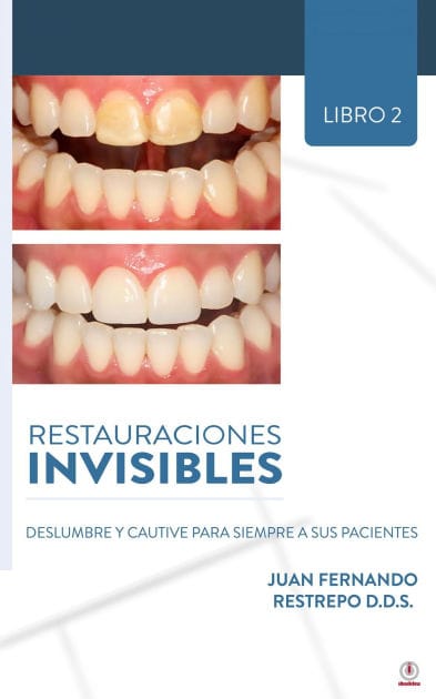 Restauraciones Invisibles: Deslumbre Y Cautive Para Siempre A Sus Pacientes