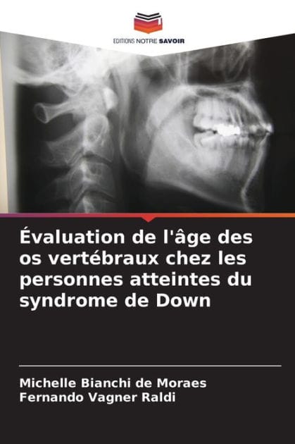 �valuation de l'�ge des os vert�braux chez les personnes atteintes du syndrome de Down